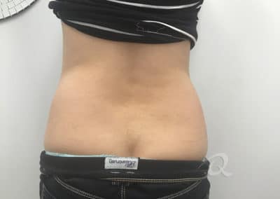 Fat Removal Before & After Photos a3