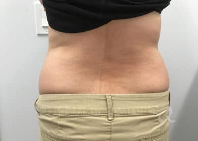 Fat Removal Before & After Picture b3