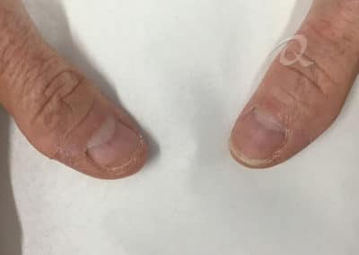 Fungal Nail Treatment Before & After Photo a1