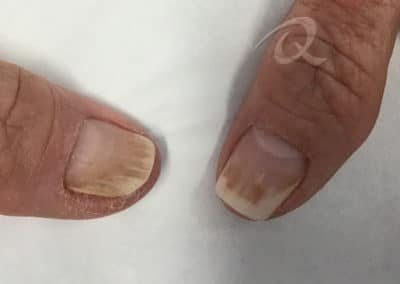 Fungal Nail Treatment Before & After Picture b1