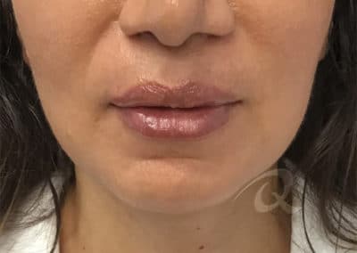 Lip Enhancement Before & After Photo a1