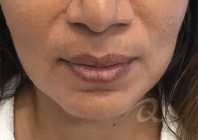 Lip Enhancement Before & After Photo b1