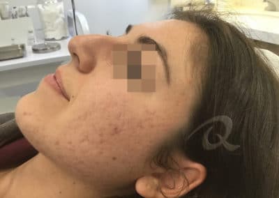 Acne Before & After Photo 55-a2