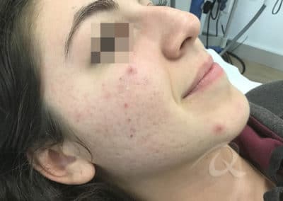 Acne Before & After Photo 55-a2