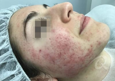 Acne Before & After Photo 55-b1