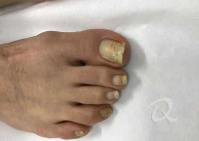 Fungal Nail Treatment Before & After Picture b5