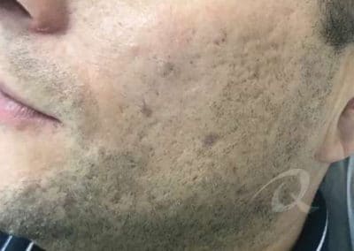 Mole Removal Before & After Picture a1