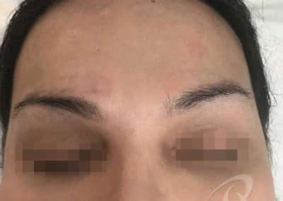 Permanent Makeup Removal Before and After Photos a1