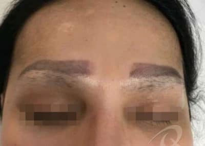 Permanent Makeup Removal Before and After Photos b1