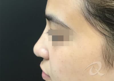 Nose Fillers Before & After Picture a1