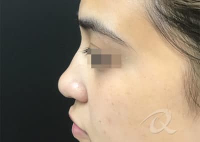 Nose Fillers Before & After Picture b1