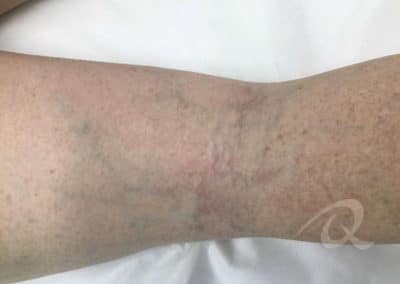 Vein Removal Before & After Picture a1