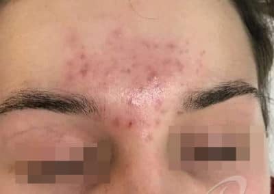Acne Before & After Photo 56
