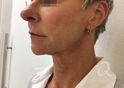 Skin tightening before after photo a1