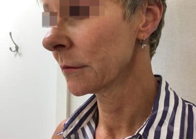 Skin tightening before after photo b1