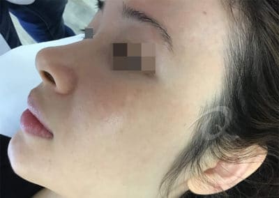 Melasma After Picture a1