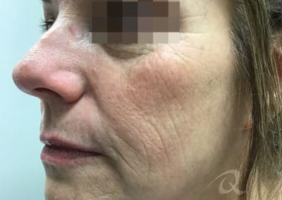 Skin tightening before after photo b3