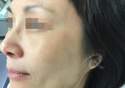 Age spot removal after picture a5