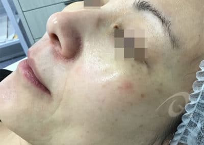 Age spot removal before picture b5