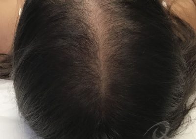 Hair Loss Before After Photo a3