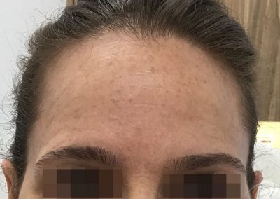 RF Skin Tightening Before & After Pictures a1