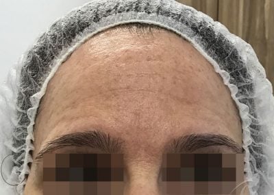 RF Skin Tightening Before & After Pictures b1