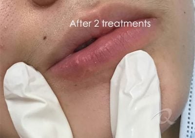 Scar Removal After Picture a12