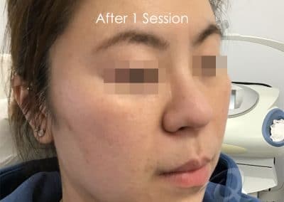 Skin tightening before after photo aa1
